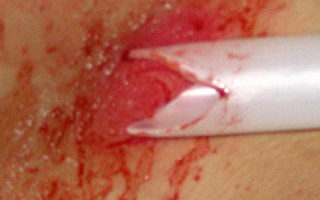 中共酷刑：硬塑料管在大腿內側鑽出血洞