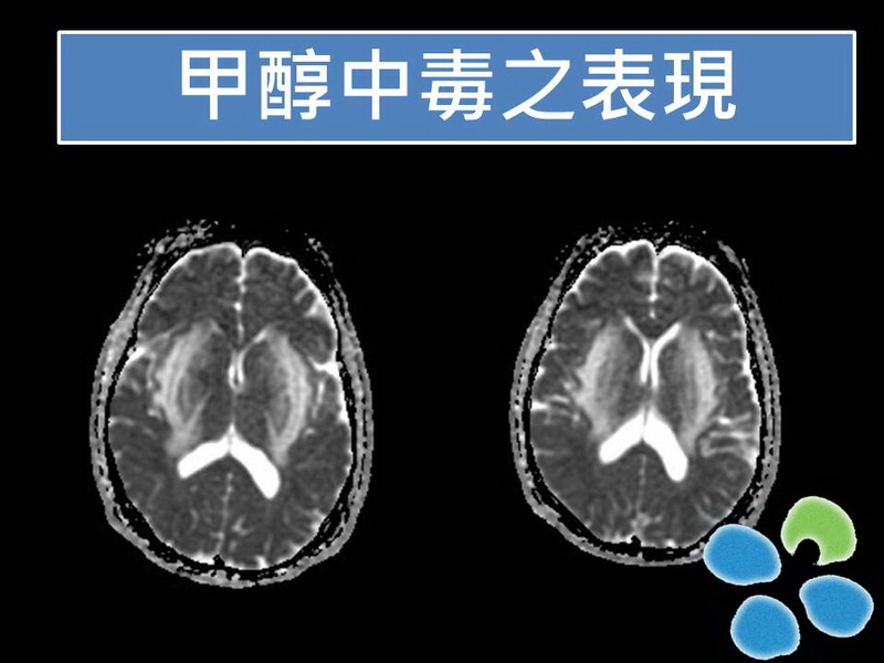 误将工业酒精当白酒 湖北三人中毒已一死