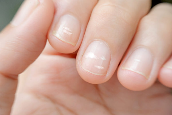 指甲出現白點可能是疾病前兆| 指甲白點| 斑點| 腎虛| 大紀元