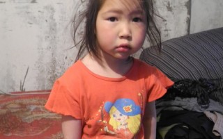 蒙古女童手缺陷   NGO跨海百萬濟助