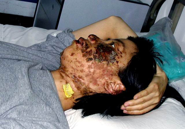 遼寧學員高蓉蓉遭獄警電擊,面部嚴重毀容。(明慧網)