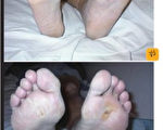 一位糖尿病患的脚底溃伤，经过BEMER的帮助，很快在几周后就愈合。（Chitvan提供）