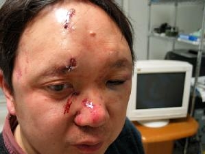 李淵博士2006年2月8日在家中遭持槍歹徒襲擊,臉上縫了15針。(大紀元) 李淵博士2006年2月8日在家中遭持槍歹徒襲擊,臉上縫了15針。(大紀元)