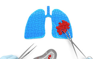肺癌的手术治疗类型
