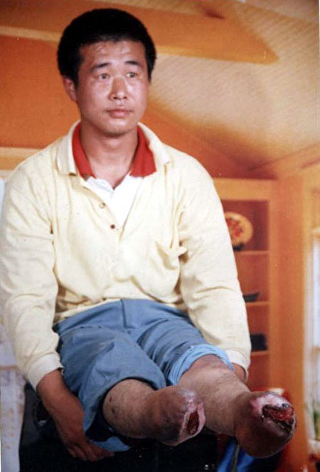 王新春被热水处理过的双脚烂没了。(明慧网)