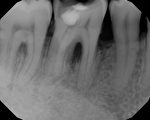 激光治牙周病 竟能长回牙槽骨