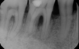 激光治牙周病 竟能長回牙槽骨
