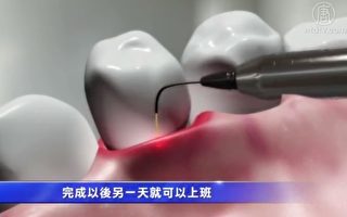 微创激光治疗牙周病 无痛无血