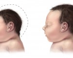 图：兹卡病毒可造成新生儿小头畸形及其它严重视觉、听力并发症，甚至导致流产和死胎。（维基百科图片）