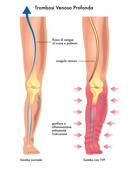 静脉栓塞较常发生在下肢，又分为深部和表浅静脉栓塞。（Fotolia）