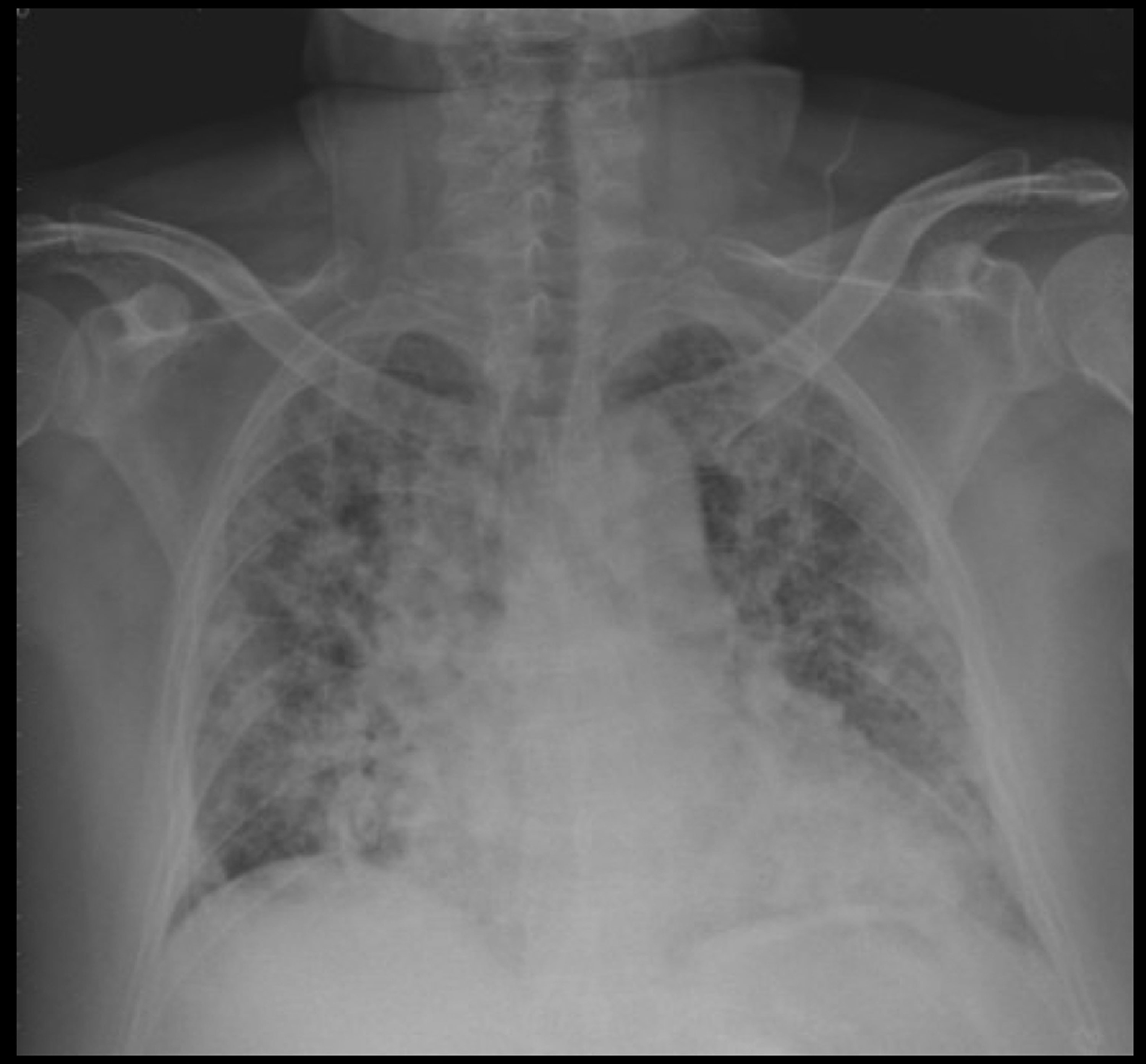 用漂白水洗厕所6旬妇人险送命 呛伤 大纪元