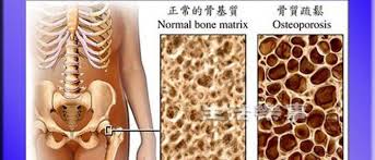 骨质疏松就是困扰很多中年女性的大问题之一。（商家提供）