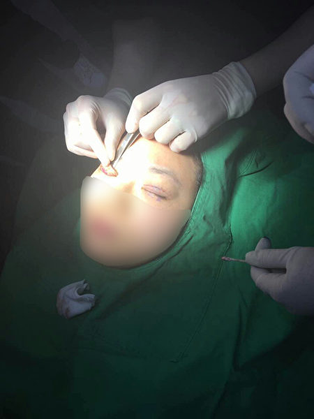 韩国非法微整形速成班上，韩国医生在做真人双眼皮施术操作演示。（知情人提供）