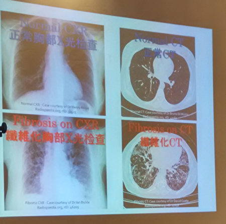 已經發生纖維化的肺部X光檢測和CT肺部造影白色部分增多。（大紀元資料圖）