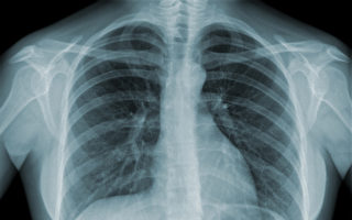 肺癌早期可治愈    哪些影像检查能诊断