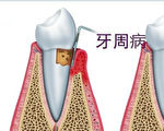牙周病可能損害全身健康 紐約牙醫談治療
