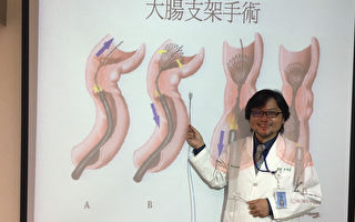 支架搭配微创手术  肠阻塞不用人工肛门