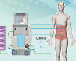 温热疗法 腹膜癌末治疗新选择