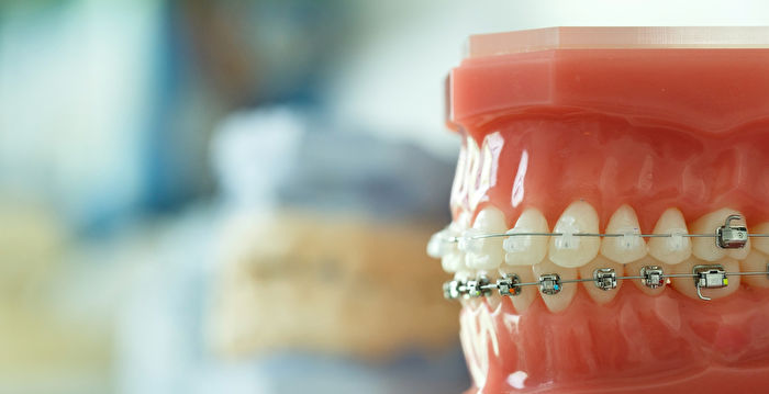 牙齿矫正前你要想清楚这4件事 后遗症 牙套 大纪元