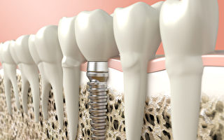 植牙耐久实用  平价享受韩裔牙医星级技术 