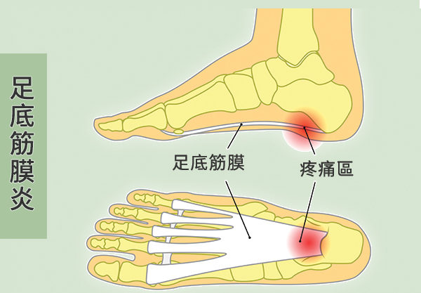 足底筋膜，就是連結腳趾骨和腳跟骨的厚厚一層組織帶。（Shutterstock/大紀元製圖）