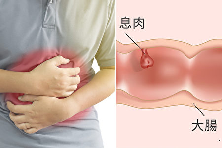 大腸息肉會癌變 專家: 護腸防癌必吃2類食物