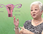 子宮肌瘤患者吃錯長更大 中醫師薦2碗藥膳