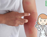 醫師：治異位性皮膚炎 「漂白水泡澡」有效