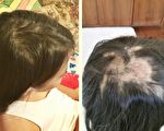 10歲女孩的禿頭神奇痊癒 母女因禍得福