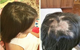 10岁女孩的秃头神奇痊愈 母女因祸得福