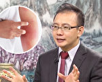 湿疹是皮肤病后期 中医教你预防+1药膳改善