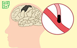 腦梗塞是最常見的腦中風！中年後做到3點能預防