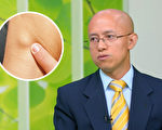 不痛反而是癌症警訊？這些症狀小心淋巴癌