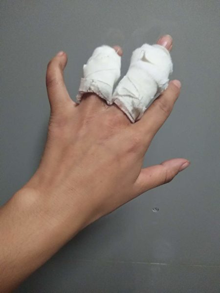 王金鳳被毆打後的傷痕。（受訪者提供）