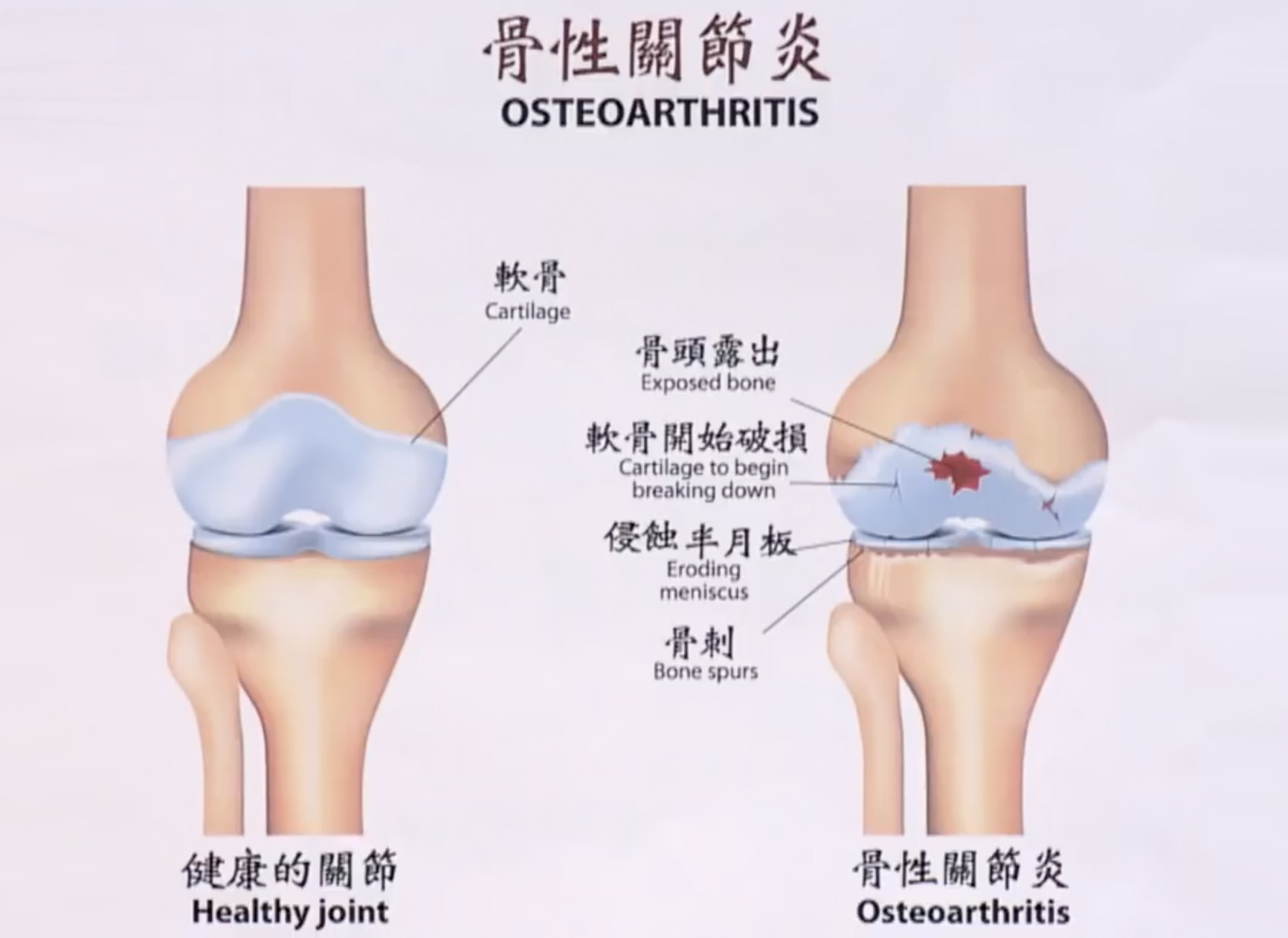 中医2招养关节拯救退化性关节炎 软骨 关节保养 关节退化 大纪元