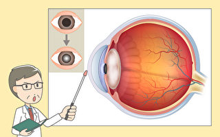 失明第一原因 白內障如何預防和保養？