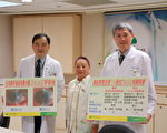 角膜水腫 DSAEK救回視力