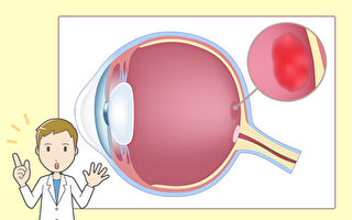眼睛出現2症狀 小心黃斑部病變 中醫治療有妙招