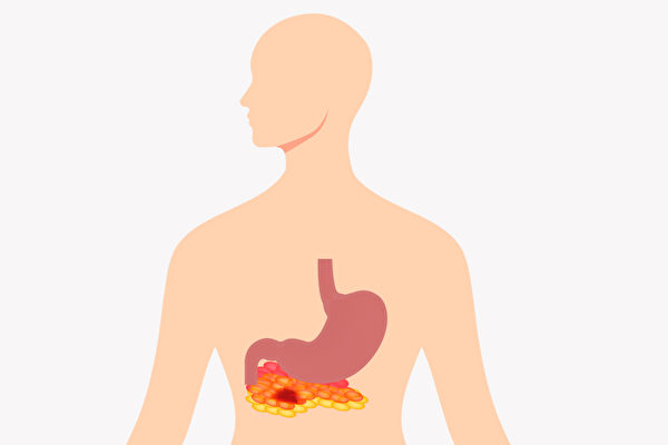 急性胰脏炎 上腹痛 是主要症状预防注意3点 胰脏炎症状 胰脏炎治疗 胰脏炎预防 大纪元