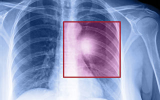 「低劑量電腦斷層」揪出早期肺癌？醫答常見4問
