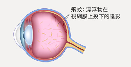 飞蚊症严格来说不是生病，是眼睛玻璃体退化。但一些症状需特别注意。(Shutterstock)