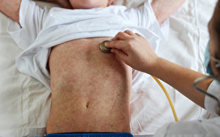 约克区确诊麻疹 卫生局更新病毒地点