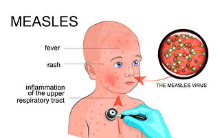 西悉尼一名婴儿感染麻疹