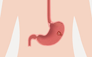 身体检查发现胃息肉怎么办？应该切除吗？(Shutterstock)