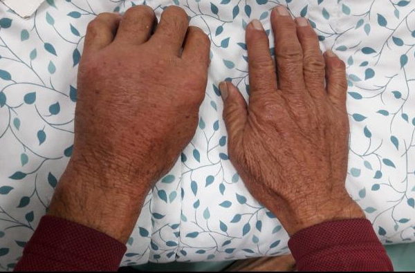 患者因染海洋分枝桿菌，左手明顯腫脹。傷口久不癒合應儘快就醫檢查。（光田綜合醫院提供）