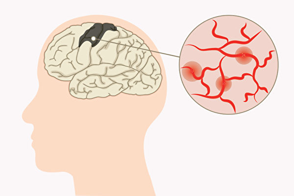 失智症分为退化性失智症和血管性失智症，哪种失智症治愈的可能性很高？（Shutterstock/大纪元制图）