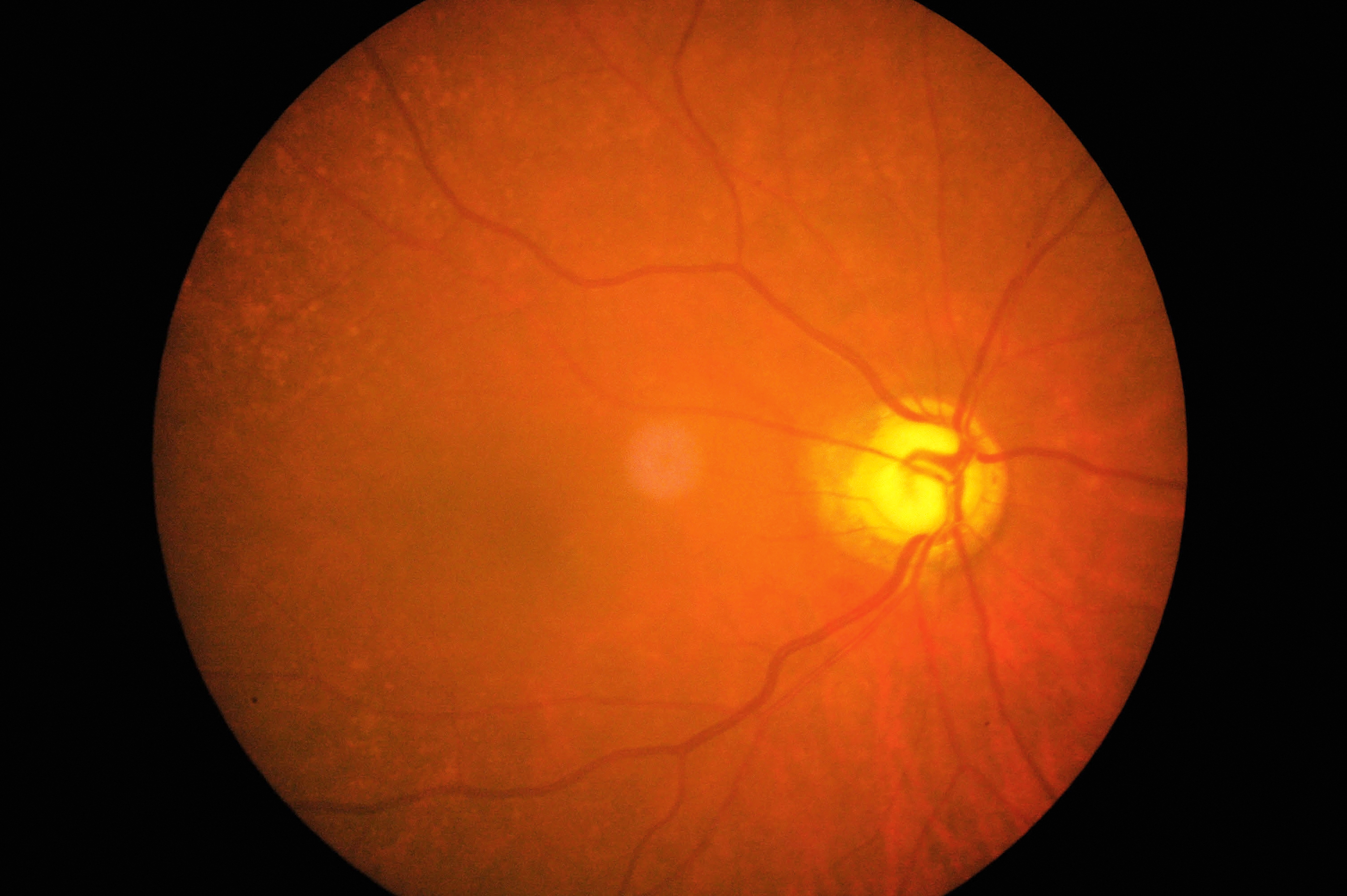 Глаукома латынь. Цитомегаловирусный хориоретинит. Пигментный ретинит сетчатки.