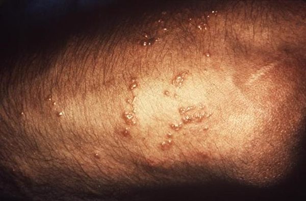 接触毒藤后的皮疹症状。（CDC／公有领域）