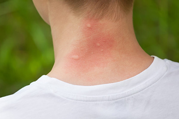 蚊子叮咬人，和人的呼吸、体温、气味、血型甚至穿衣颜色都有关系。(Shutterstock)