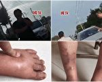 江天勇双脚严重浮肿就医被阻 妻急吁关注
